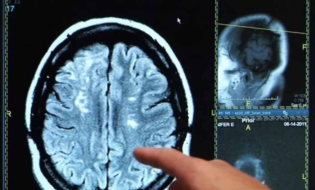 La generación X está en mayor riesgo de accidente cerebrovascular que los 'baby boomers'