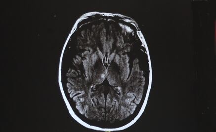 La curación de lesiones cerebrales podría relacionarse con un tipo de cáncer