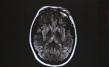 La curación de lesiones cerebrales podría relacionarse con un tipo de cáncer