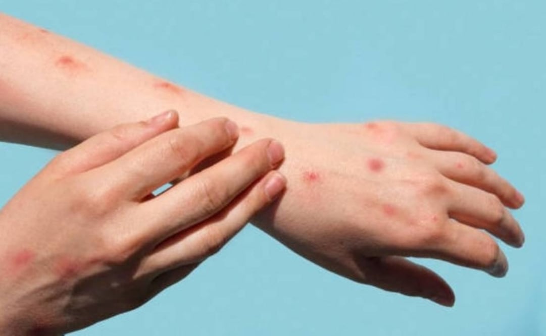 Suman cuatro casos de viruela símica en Yucatán; mantienen activa la alerta sanitaria.
Foto: Especial.