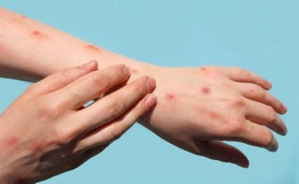 Suman cuatro casos de viruela símica en Yucatán; mantienen activa la alerta sanitaria