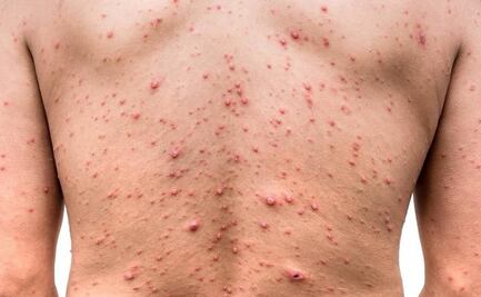 Confirman tercer caso de viruela del mono en Chihuahua