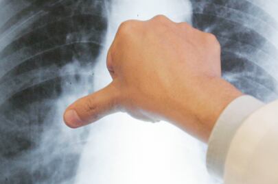 Hipertensión pulmonar, un peligro de muerte