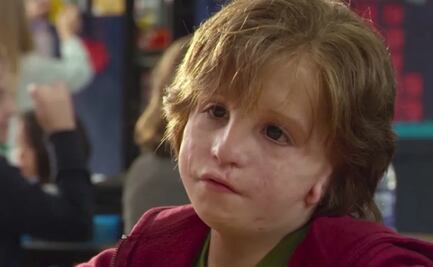 ¿Qué es el síndrome de Treacher Collins?; conoce sus principales síntomas