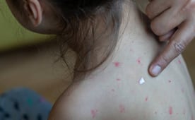 Se eleva a 41 el número de fallecimientos por brote de sarampión en México; van 17 mil 617 contagios
