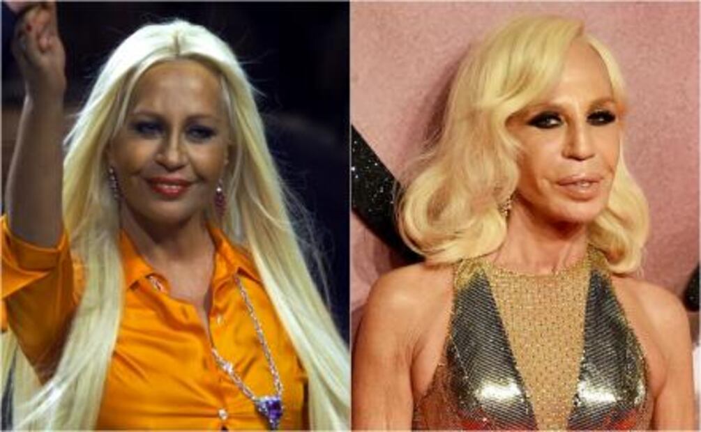 Personalidades de la moda que se pasaron de cirugías