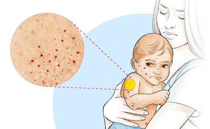 Sarampión, de nuevo una amenaza