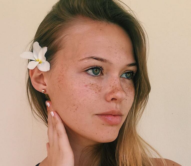 Disminuye la apariencia de las pecas con estas recomendaciones de los dermatólogos. Foto: Instagram