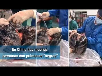 Negros e inservibles: así recibió pulmones para donación un médico en China