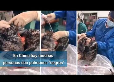 Negros e inservibles: así recibió pulmones para donación un médico en China