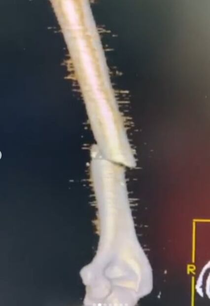 El piloto Marc Márquez presume las radiografías de su fractura 