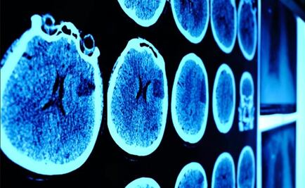 Imágenes en 3D dan nuevas pistas de la enfermedad de Hungtinton