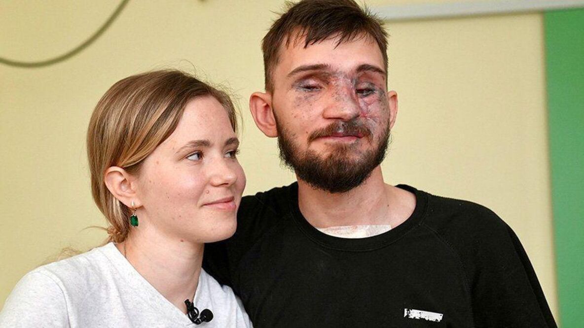 “Se necesita una nueva definición de belleza en Ucrania”: el creciente número de amputados en la guerra contra Rusia. Fot: BBC