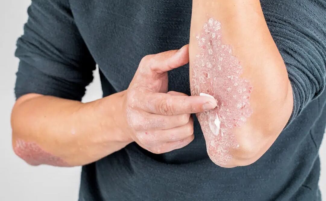 La psoriasis afecta principalmente a adultos mayores. Foto: Shutterstock