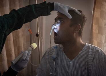 Preguntas clave sobre la rara infección por hongos que ataca a pacientes con Covid-19 en India