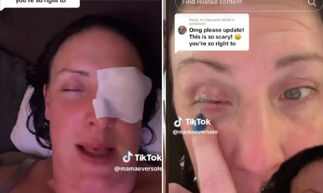 Jennifer Eversole terminó en el hospital, al confundir unas gotas de ojo con pegamento, en California, Estados Unidos. FOTO: TikTok: @mamaeversole