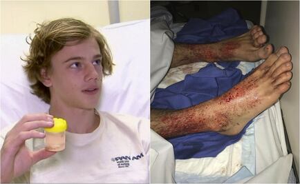 Criaturas marinas "comen" pies de joven en Australia