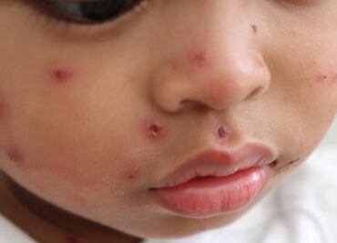 Canadá pierde estatus de país libre de sarampión; reportan baja tasa de vacunación en comunidades cristianas menonitas