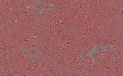 Descubren un nuevo linfocito que mata las células cancerosas