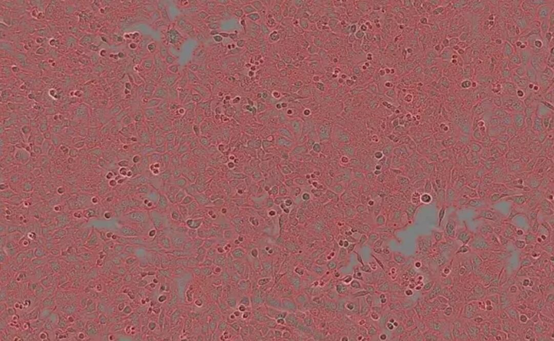 Células cancerosas. Foto: Universidad de Tel Aviv, archivo