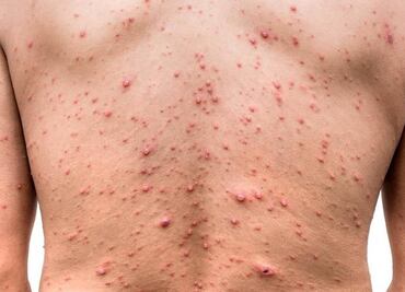 Suman cuatro casos sospechosos de viruela del mono en Sinaloa