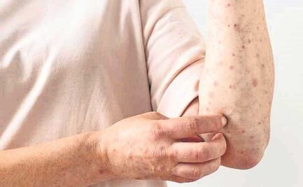 Salud registra 60 casos de viruela del mono en los últimos 14 días en México