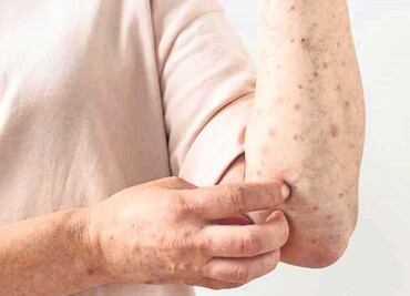 Salud registra 60 casos de viruela del mono en los últimos 14 días en México