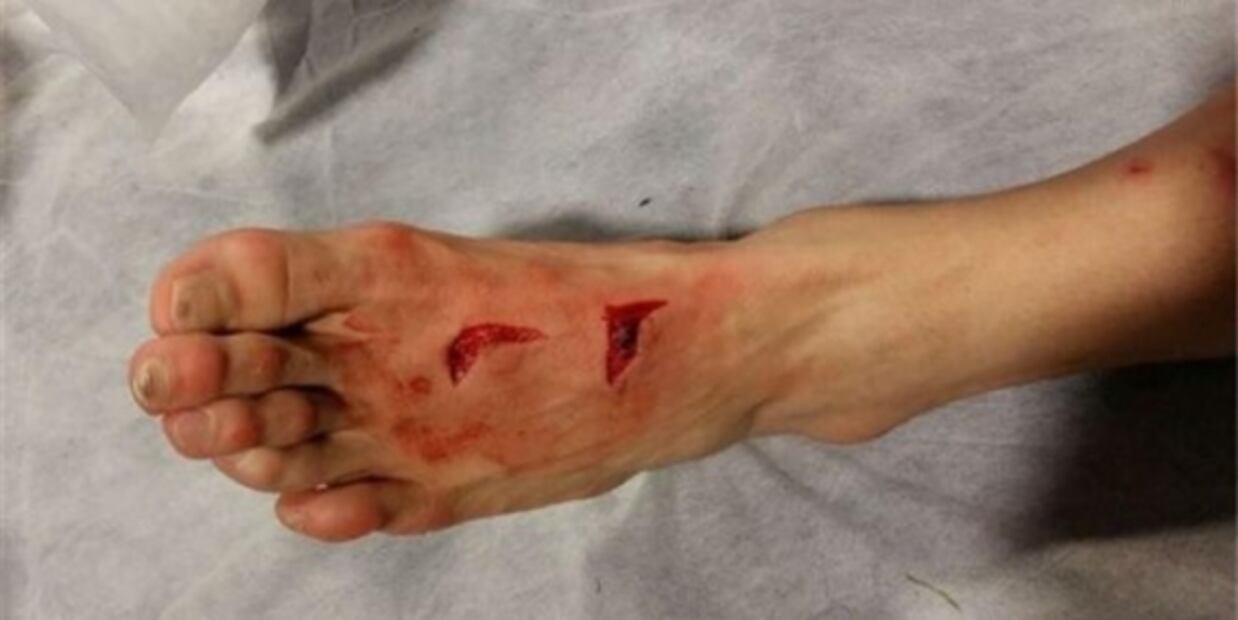 Las peores heridas por arteras entradas en el futbol