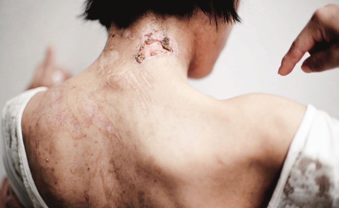 La joven mostró sus heridas al escapar. Foto: Archivo EL UNIVERSAL