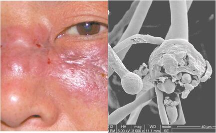 Mucormicosis: Infección oportunista que causa estragos en la India