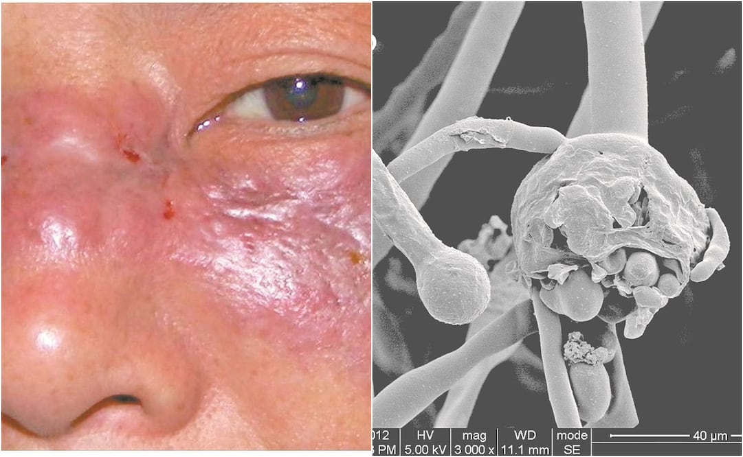 Lesión causada por un hongo del género Rhizopus. A la derecha, imagen de este hongo vista al microscopio. Foto: Especial.