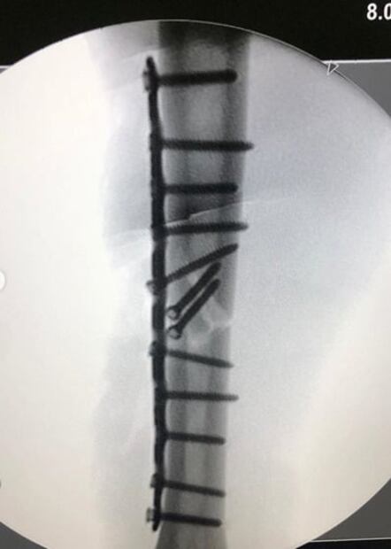 El piloto Marc Márquez presume las radiografías de su fractura 