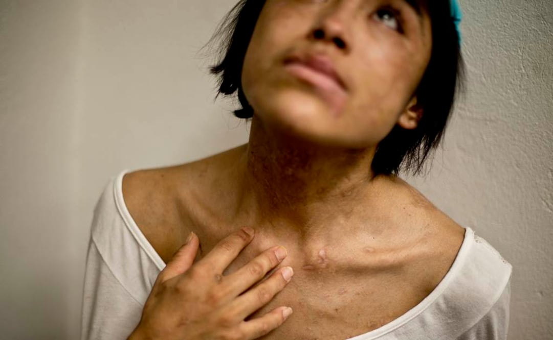 Zunduri, tras su liberación el 27 de abril pasado. Fotografía de Arturo Bermúdez