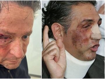 Alfredo Adame muestra su rostro tras cirugía: "A Fabiruchis le pegaron más"