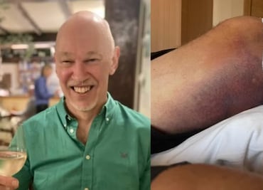 Rascarse le costó la vida: el hombre que murió por una bacteria carnívora en Turquía