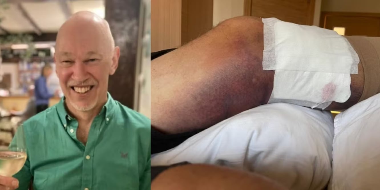 Phillip Maile, fue llevado de emergencia al hospital después de que su pierna comenzara a volverse negra y azul. FOTO: REDES SOCIALES