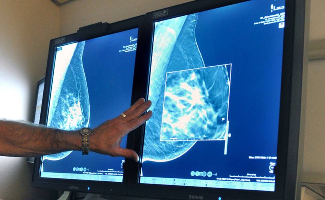 Un radiólogo compara dos imágenes de una mamografía. Foto: AP