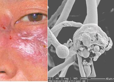 Reportan tercer caso sospechoso de hongo negro por Covid-19 en Oaxaca