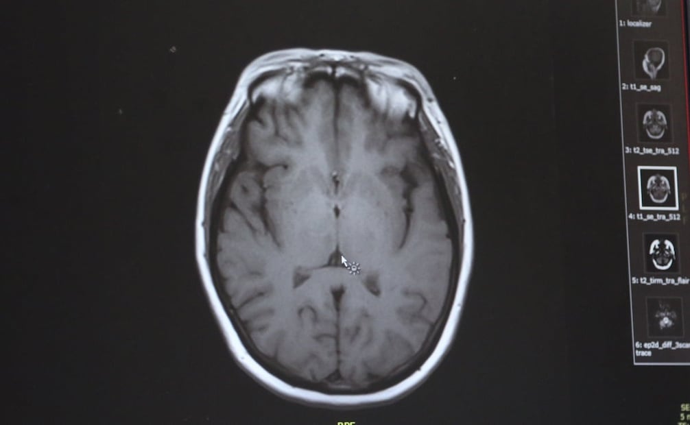 El organismo viaja por la nariz hasta el cerebro, en donde suele causar infección cerebral Foto: Archivo. EL UNIVERSAL
