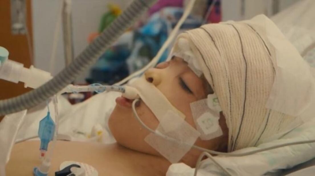 Fotos. Logran con éxito separación de siameses unidos por la cabeza en Brasil