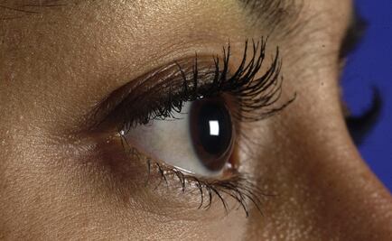 Blefaroplastía, opción para corregir caída de párpados