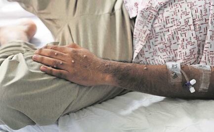 ¿En dónde se reportan más casos de viruela símica en México?