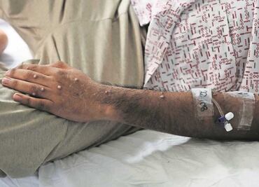 Especialista no ve señales de alarma por mpox en México con 72 casos