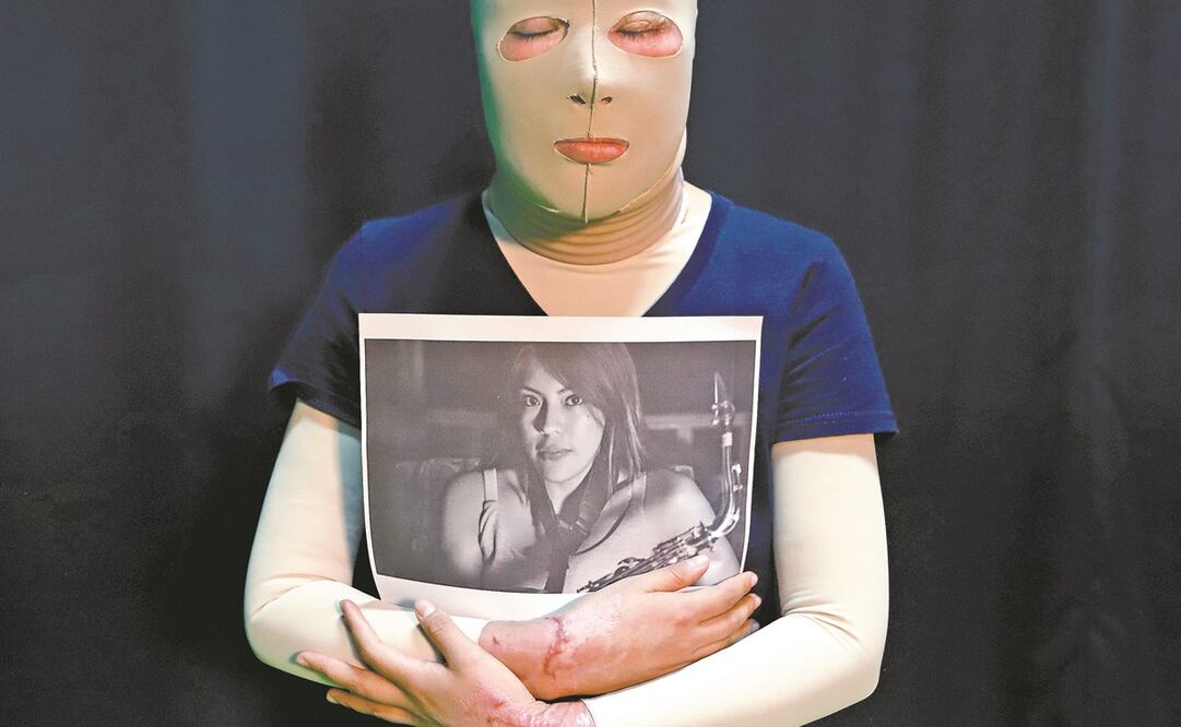 María Elena Ríos fue atacada con ácido en 2019; la joven resultó con severas quemaduras.