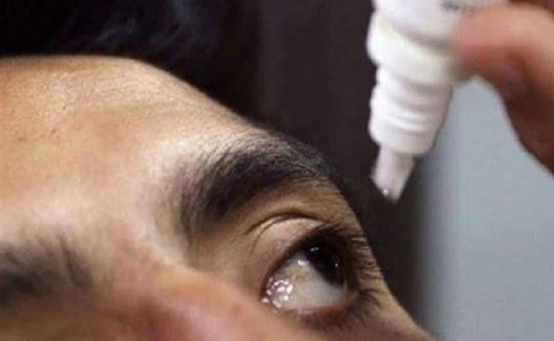 Aumentan contagios de conjuntivitis en Yucatán. Foto: Especial.