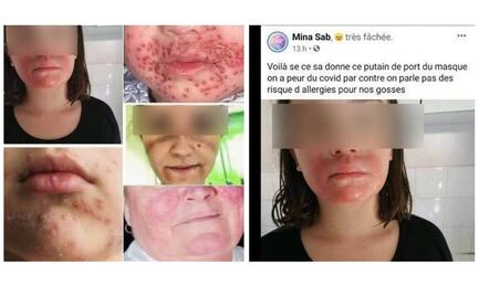 ¿Cubrebocas contra el Covid pueden causar enfermedades en la piel? 