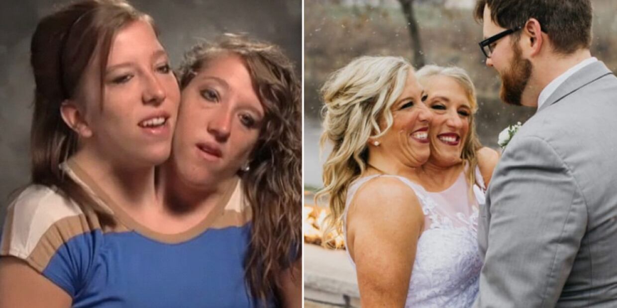 Abby y Brittany Hensel son siamesas bicéfalas. FOTO:
Instagram: @abbyandbrittany