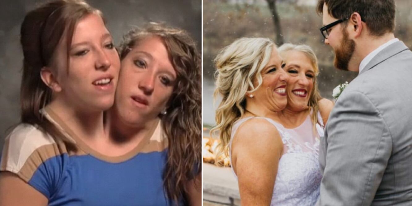 Abby y Brittany Hensel son siamesas bicéfalas. FOTO: Instagram: @abbyandbrittany