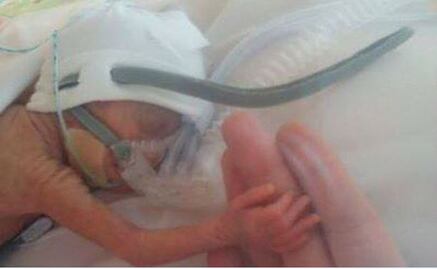 200,000 preemies are born in Mexico every year