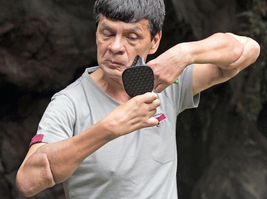 Hace tres años y seis meses, Gabriel Granados fue el protagonista del primer trasplante de brazos en América Latina (JUAN CARLOS REYES)